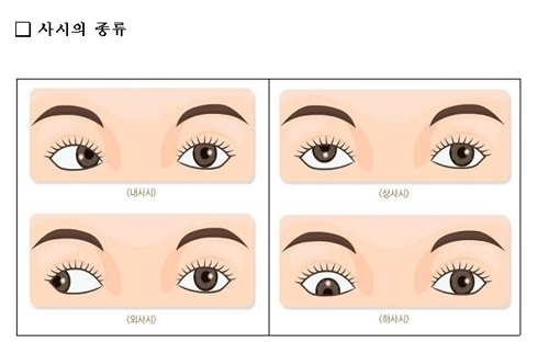 사시 환자 절반은 9세 이하 아동…작년 진료인원 13만명
