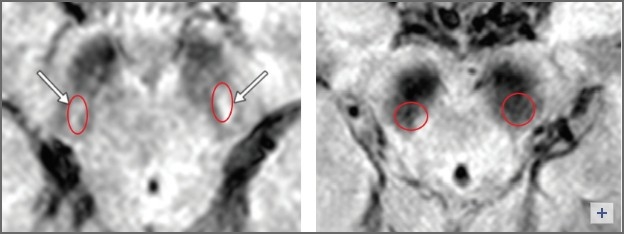 MRI 검사 통해 세계 최초로 렘수면 행동장애 환자 파킨슨병 진행 여부 예측