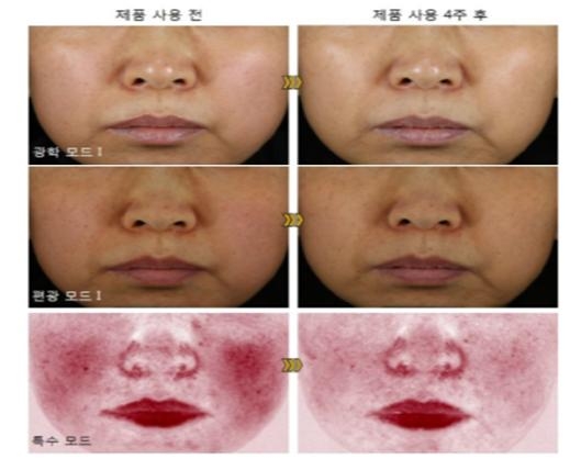 토종 유산균, 아토피 피부염 완화 효과